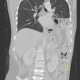 Rupture of the diaphragm, diaphragmatic hernia: CT - Computed tomography